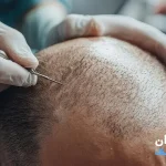 بهترین کلینیک های کاشت مو در تهران [ تهران کلینیک : tehranclinik ir ] کاشت مو در تهران