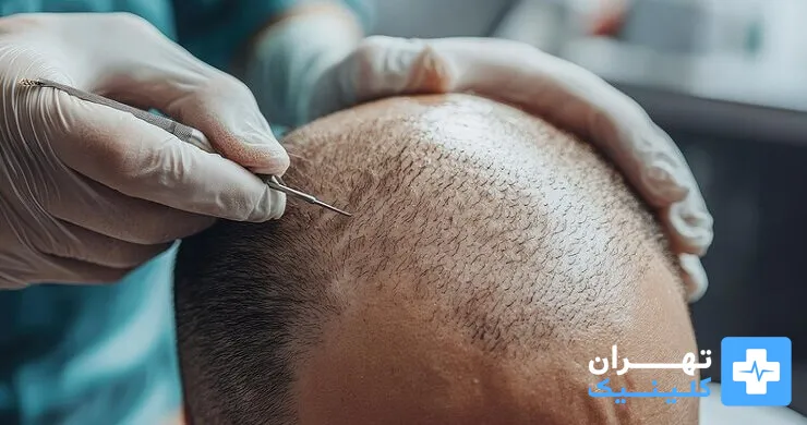 بهترین کلینیک های کاشت مو در تهران [ تهران کلینیک : tehranclinik ir ] کاشت مو در تهران