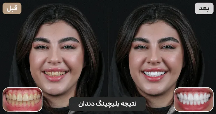 عکس قبل و بعد بلیچینگ دندان در تهران | دایرکتوری پزشکی تهران کلینیک [ tehranclinik.ir ]
