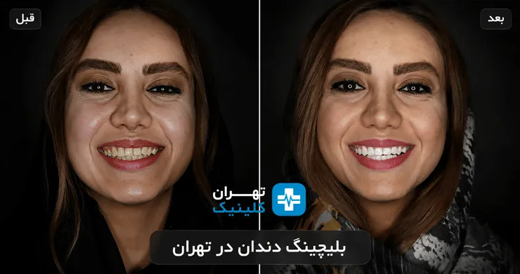 عکس قبل و بعد بلیچینگ دندان در تهران | دایرکتوری پزشکی تهران کلینیک [ tehranclinik.ir ]