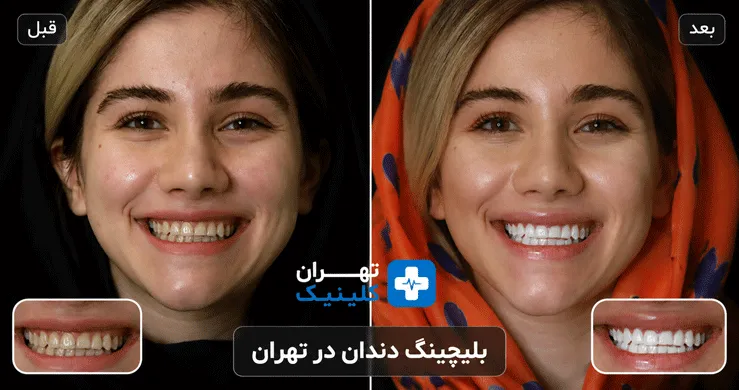 عکس قبل و بعد بلیچینگ دندان در تهران | دایرکتوری پزشکی تهران کلینیک [ tehranclinik.ir ]