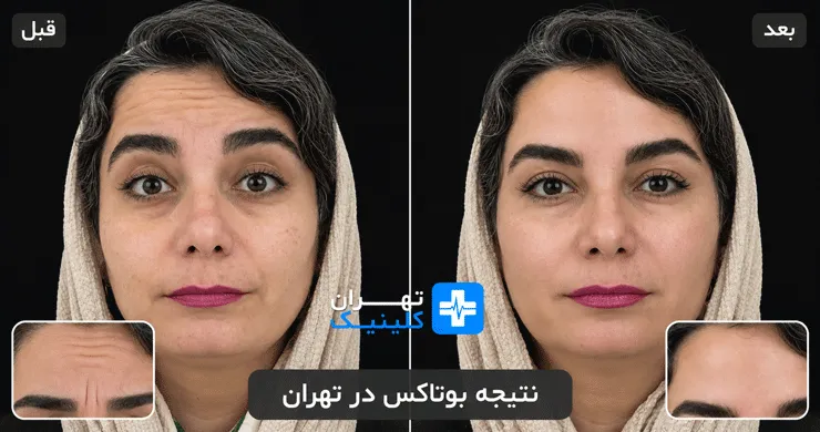 عکس قبل و بعد از بوتاکس در تهران | دایرکتوری پزشکی تهران کلینیک [ tehranclinik.ir ]