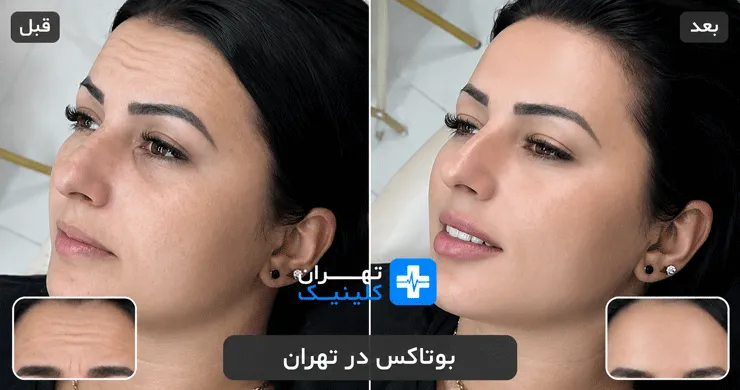 عکس قبل و بعد از بوتاکس در تهران | دایرکتوری پزشکی تهران کلینیک [ tehranclinik.ir ]