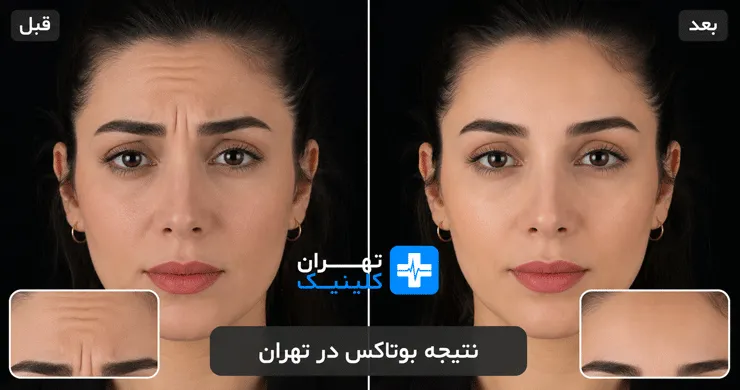 عکس قبل و بعد از بوتاکس در تهران | دایرکتوری پزشکی تهران کلینیک [ tehranclinik.ir ]