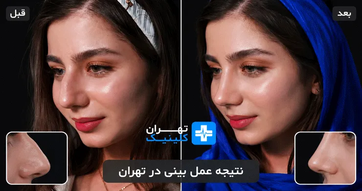 عکس قبل و بعد از عمل بینی در تهران | دایرکتوری پزشکی تهران کلینیک [ tehranclinik.ir ]
