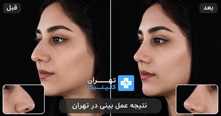 عکس قبل و بعد از عمل بینی در تهران | دایرکتوری پزشکی تهران کلینیک [ tehranclinik.ir ]