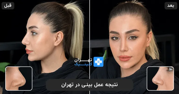 عکس قبل و بعد از عمل بینی در تهران | دایرکتوری پزشکی تهران کلینیک [ tehranclinik.ir ]
