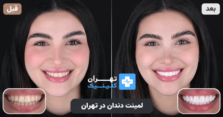 عکس قبل و بعد لمینت دندان در تهران | دایرکتوری پزشکی تهران کلینیک [ tehranclinik.ir ]