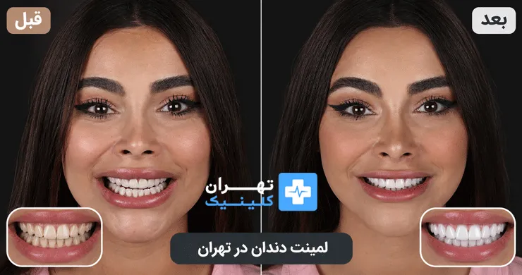 عکس قبل و بعد لمینت دندان در تهران | دایرکتوری پزشکی تهران کلینیک [ tehranclinik.ir ]
