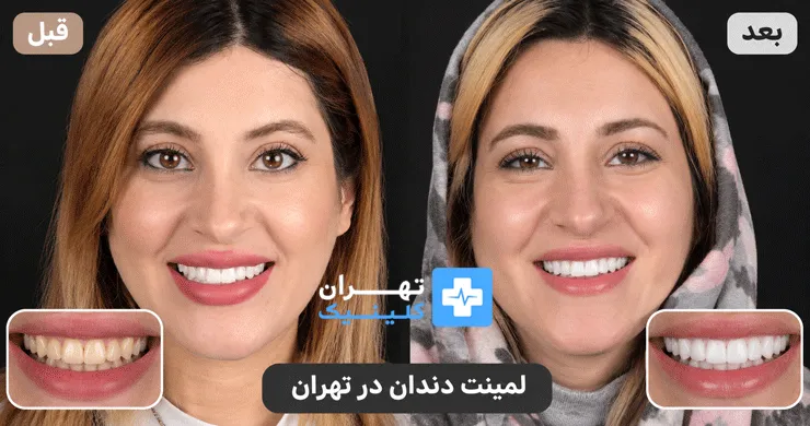 عکس قبل و بعد لمینت دندان در تهران | دایرکتوری پزشکی تهران کلینیک [ tehranclinik.ir ]