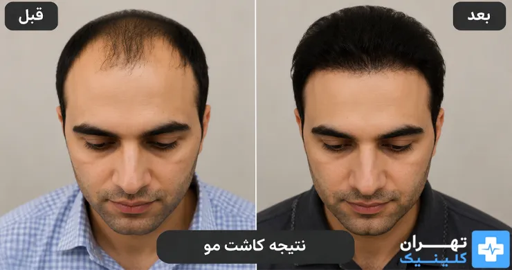 عکس قبل و بعد کاشت مو در تهران | دایرکتوری پزشکی تهران کلینیک [ tehranclinik.ir ]