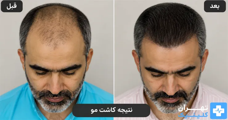 عکس قبل و بعد کاشت مو در تهران | دایرکتوری پزشکی تهران کلینیک [ tehranclinik.ir ]