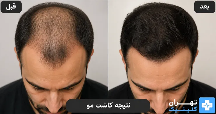 عکس قبل و بعد کاشت مو در تهران | دایرکتوری پزشکی تهران کلینیک [ tehranclinik.ir ]