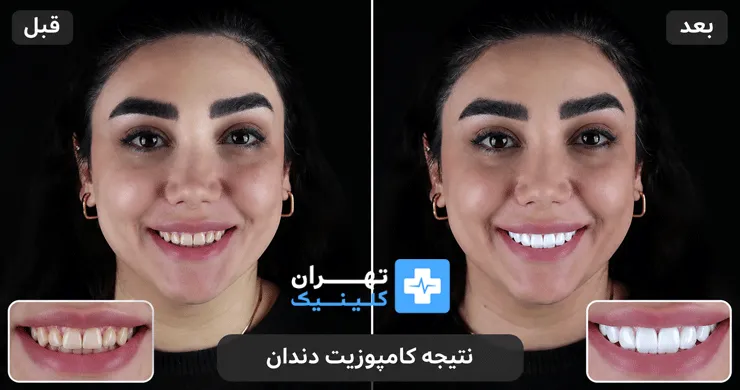 عکس قبل و بعد کامپوزیت دندان در تهران | دایرکتوری پزشکی تهران کلینیک [ tehranclinik.ir ]