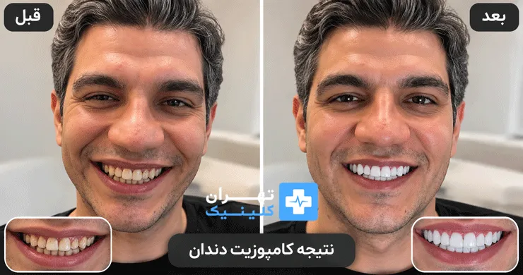 عکس قبل و بعد کامپوزیت دندان در تهران | دایرکتوری پزشکی تهران کلینیک [ tehranclinik.ir ]