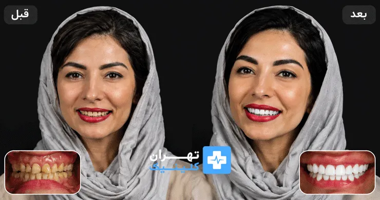عکس قبل و بعد کامپوزیت دندان در تهران | دایرکتوری پزشکی تهران کلینیک [ tehranclinik.ir ]